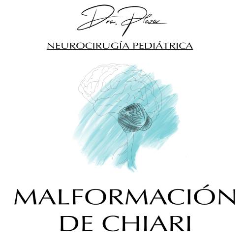malformacion de chiari
